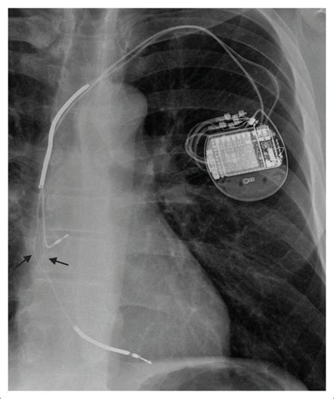 Chest Radiographs Of Cardiac Devices Part 1 Cardiovascular