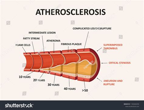 10667 Atherosclerosis 이미지 스톡 사진 및 벡터 Shutterstock