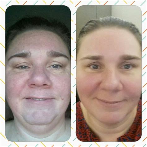 Amazing Results Using Rf Soothe Regimen Let Me Help You