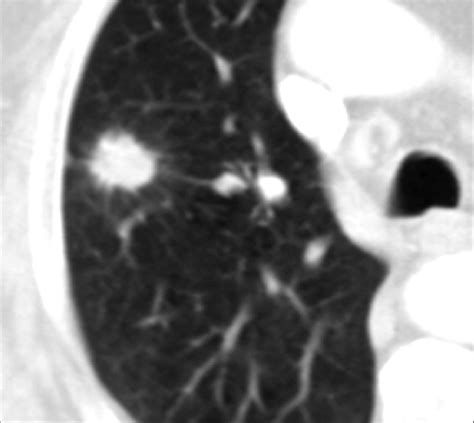 Granuloma Lung Ct Scan Ct Scan Machine Images And Photos Finder