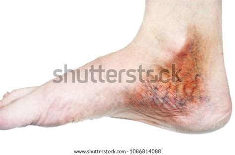 Human Leg Blocked Veins Thrombosis Phlebitis Foto Stok 1086814088