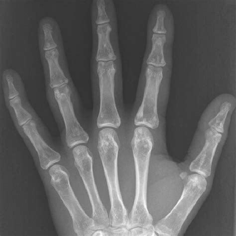 Pyknodysostosis Posteroanterior Radiograph Of The Hands Shows Dense
