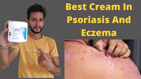 Best Cream In Psoriasis And Eczema How To Treat Psoriasis Naturally