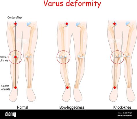 Valgus Deformities Healthy Joint Knock Knee And Bow Leggedness Human