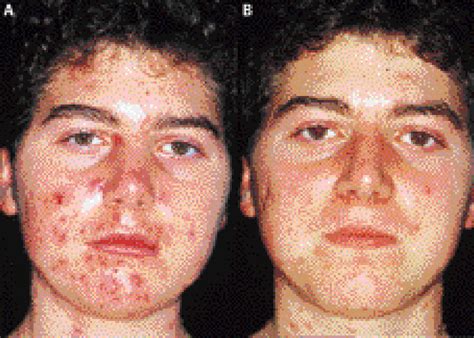 Acne Fulminans In Late Onset Congenital Adrenal Hyperplasia The Lancet