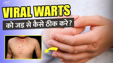 Viral Warts को जड़ से कैसे ठीक करे Homeopathic Treatment And Medicine