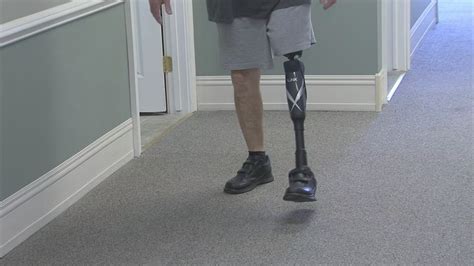 Bionic Leg Is Giving Amputees Life Changing Help 6abc Philadelphia