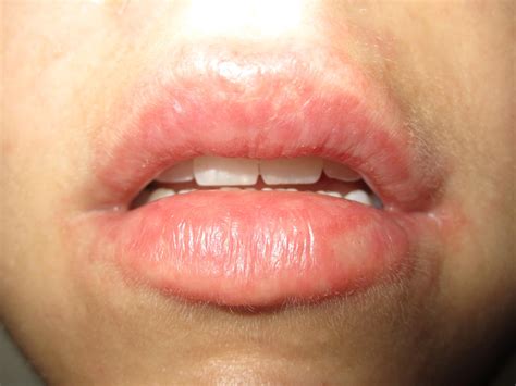Allergic Reaction Lips Pictures Photos