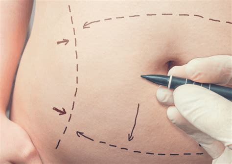 A tummy tuck can include a long incision, the removal of skin and fat, the suturing or plication of abdominal muscles, along with liposuction. How To Sleep After Tummy Tuck: The Complete Guide