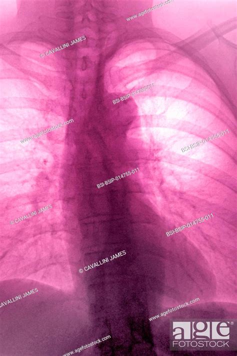 Calcified Atheromatous Of The Aortic Arch Frontal Thoracic X Ray