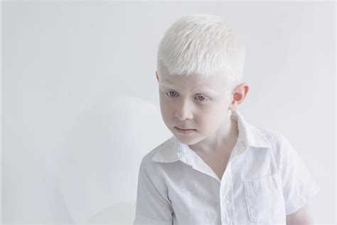 Albinism Photographs Yulia Taits Popsugar Beauty Photo 9