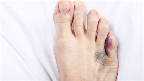 Pinky Toe Pain 4 Common Conditions That Cause Pinky Toe Pain