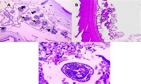 Aandb Histopathology Of Hydatid Cyst A Broad Capsule Containing