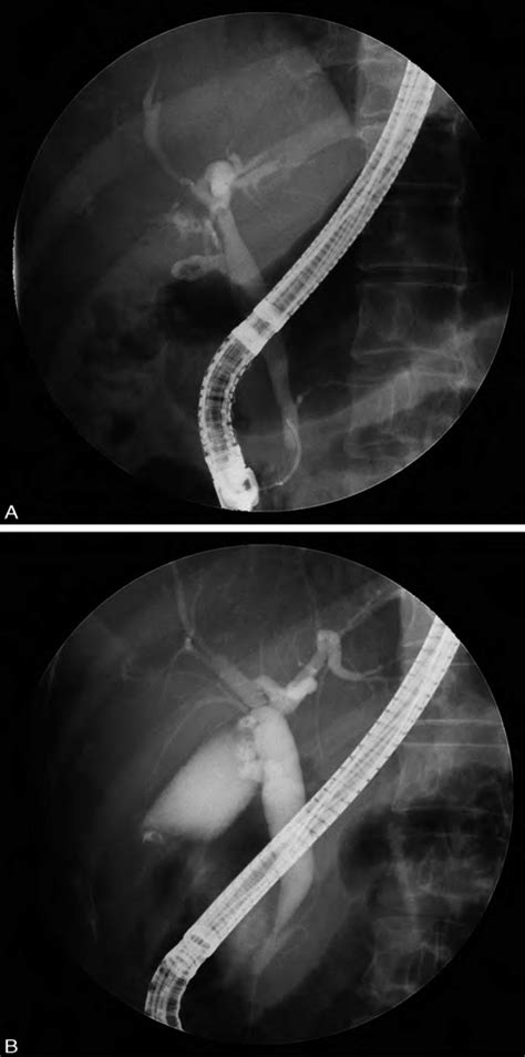 A Endoscopic Retrograde Cholangiopancreatography Ercp Shows The Main