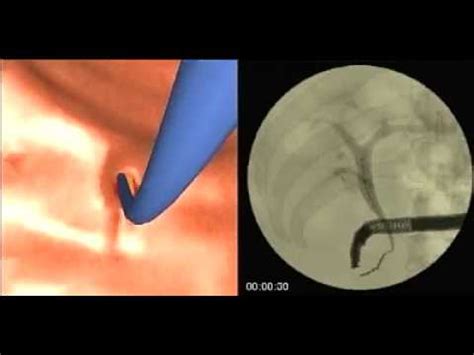 ERCP Stenting YouTube