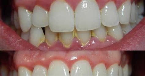 Jika dipasang di klinik kerajaan, berapakah harga pendakap gigi yang akan dikenakan? Harga Cuci Gigi Klinik Kerajaan