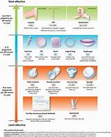 Images of Information About Iud Birth Control