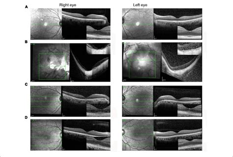 Spectral Domain Optical Coherence Tomography Images Of The Fovea A