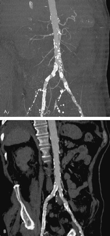 Abdominal Aorta And Iliac Arteries As Visualized By Computed Tomography