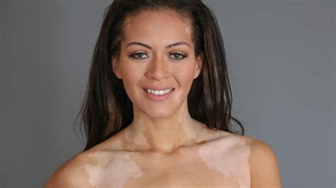 Woman Who Was Bullied For Having Skin Condition Vitiligo Gets Last Laugh After Being Crowned