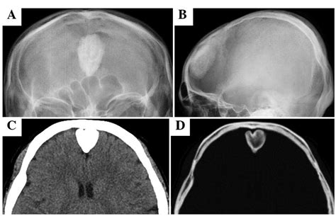 Surgical Case Of Intracranial Osteoma Arising From The Falx