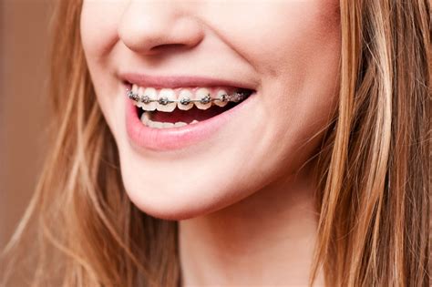 Generally speaking, however, retainers should be worn as much as possible for the first 4 to 6 months after treatment and thereafter at least 8 hours per day. Braces: How Long Will They Stay on My Teeth? | The ...
