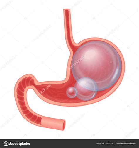 Realistic medical illustration of Abdominal bloated stomach isolated