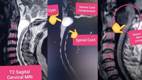 Spinal Cord Cyst Youtube