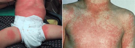 Rheumatic Fever Rash