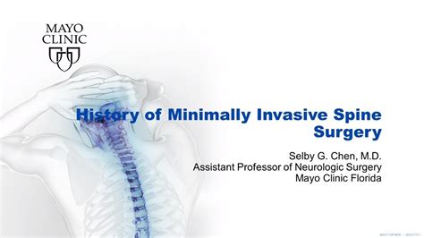 History Of Minimally Invasive Spine Mis Surgery By Selby G Chen Md