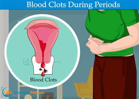 Blood Clots During Period Period Blood Clots Causes And Symptoms Healthmd