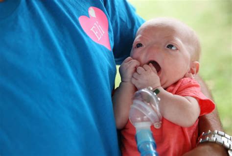 Baby Born Without Nose Is Very Cute Pictures Going Viral Style Hunt World