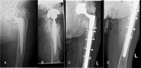Revision Hip Arthroplasty Using A Modular Revision Hip System In Cases