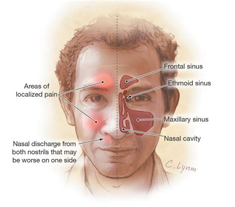 Sinusitis Acute Causes Symptoms Treatment Sinusitis Acute