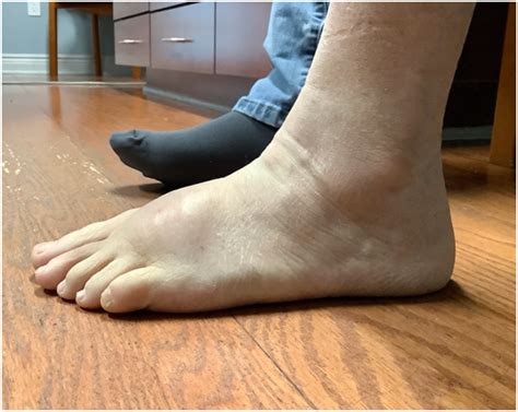 Ganglion Cysts Of The Foot Ankle Lifootcare Com