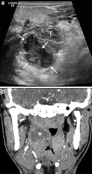 Peritonsillar Abscess In A 17 Year Old Boy With 7 Days History Of Sore