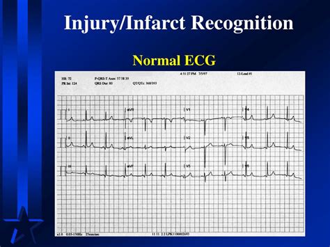 Ppt 12 Lead Ecgs Ischemia Injury And Infarction Powerpoint