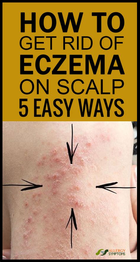 How To Get Rid Of Eczema On The Scalp Allergy Symptoms