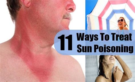 11 Ways To Treat Sun Poisoning With Images Sun Poisoning Treatment