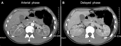 Contrast Enhanced Abdominal Computed Tomography Ct A Arterial