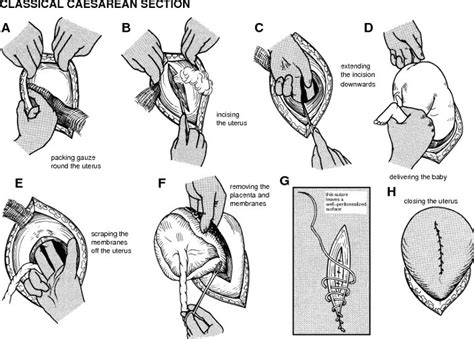 C Section Caesarean Section Cesarean Section Illustration