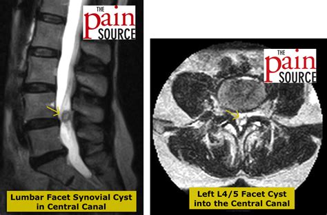 Posterior Synovial Cyst Spine