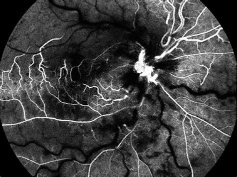 Scielo Brasil Retinal Vein And Artery Occlusion As The First