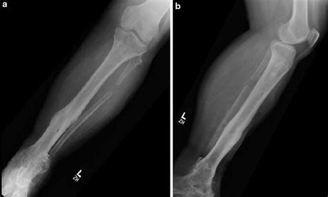 10 Infected Nonunion Of The Tibia Plastic Surgery Key