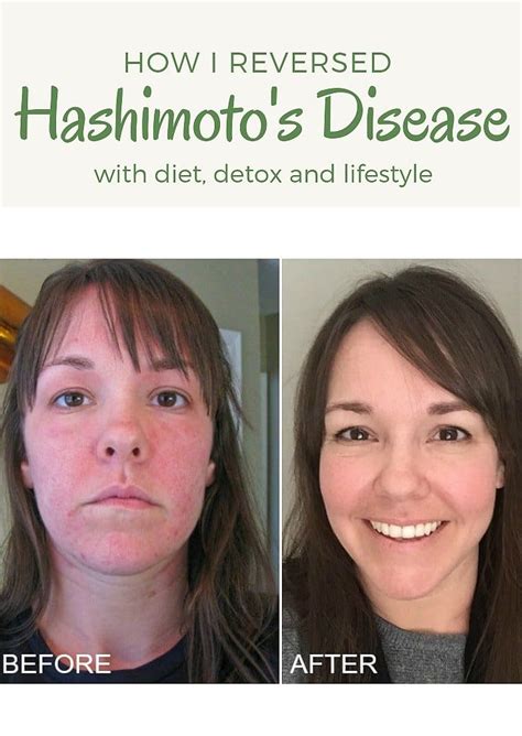 How I Reversed Hashimotos Disease With Diet And Detox Thyroid Diet Hashimotos Disease