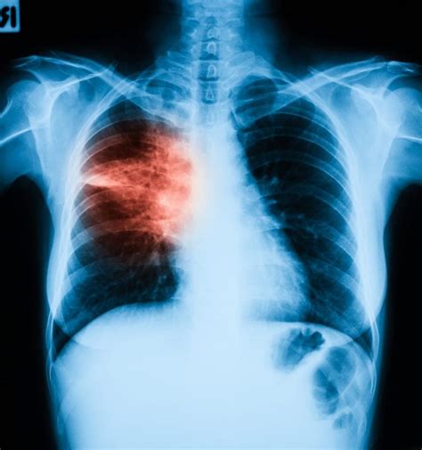 What Is Aspiration Pneumonia Facty Health