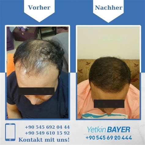 Haartransplantation Türkei Vorher Nachher Ergebnisse | Dr. Bayer Clinics