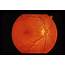 Optic Neuritis  Retina Image Bank