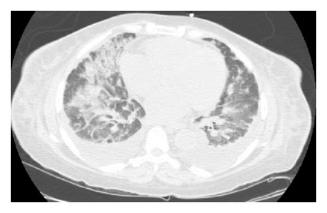 Ct Chest Showing Bilateral Alveolar Infiltrates And Ground Glass