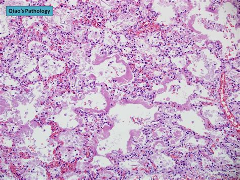 Qiao S Pathology Hyaline Membrane Disease Infant Respira Flickr